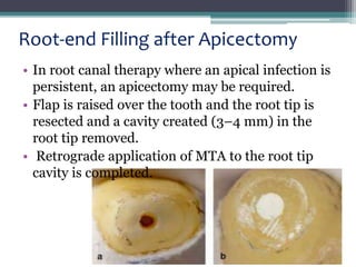 MTA & Biodentine | PPTX