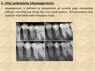 3. Vital pulpotomy (Apexogenesis):
• Apexogenesis is defined as amputation of coronal pulp completely
without inserting any thing into root canal system. This procedure was
used for vital teeth with immature roots.
 