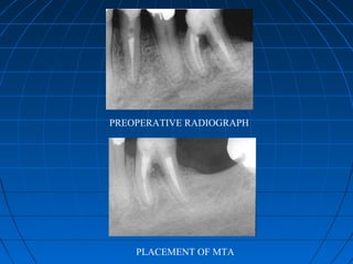 PREOPERATIVE RADIOGRAPH




    PLACEMENT OF MTA
 
