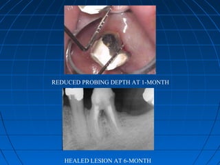 REDUCED PROBING DEPTH AT 1-MONTH




   HEALED LESION AT 6-MONTH
 