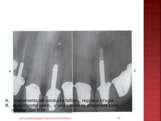 A. tratamiento de conducto fallido,, requiere cirugia.
B. resecciondel apice, y una cavida es preparada para
   rellenar con MTA
      UNFV ODONTOLOGIA- NESTOR TAFUR CHAVEZ          46
 