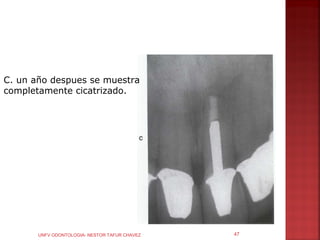 C. un año despues se muestra
completamente cicatrizado.




       UNFV ODONTOLOGIA- NESTOR TAFUR CHAVEZ   47
 