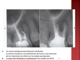 A.   Un canal mesiobucal parcialmente calcificado.
     La camara resulto en una perforacion de furca y una extrucion
     de los materiales de relleno en los tejidos periapicales.
B.   La pieza ODONTOLOGIA- NESTOR TAFUR CHAVEZ fue sellada con MTA
          UNFV fue retratada y la perforacion                        48
 