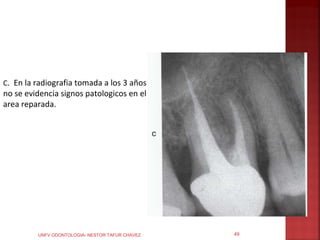 C. En la radiografia tomada a los 3 años
no se evidencia signos patologicos en el
area reparada.




         UNFV ODONTOLOGIA- NESTOR TAFUR CHAVEZ   49
 