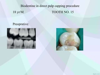 Biodentine in direct pulp capping procedure
18 yr/M TOOTH NO. 15
Preoprative:
 