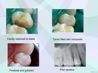 Cavity reduced to base Cavity filled with composite
Finalized and polished Post oprative
 