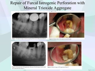 Repair of Furcal Iatrogenic Perforation with
Mineral Trioxide Aggregate
 