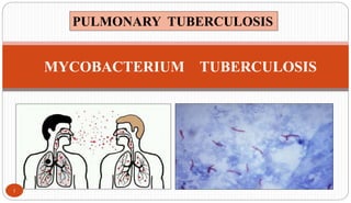 MYCOBACTERIUM TUBERCULOSIS
1
PULMONARY TUBERCULOSIS
 