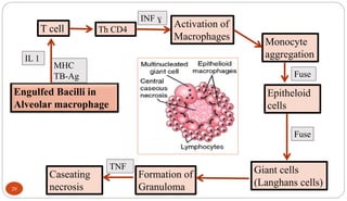 20
Engulfed Bacilli in
Alveolar macrophage
T cell Th CD4
Activation of
Macrophages
Monocyte
aggregation
Epitheloid
cells
Giant cells
(Langhans cells)
Formation of
Granuloma
IL 1
MHC
TB-Ag
INF ɣ
TNF
Fuse
Fuse
Caseating
necrosis
 