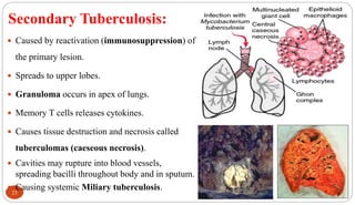 23
Secondary Tuberculosis:
 Caused by reactivation (immunosuppression) of
the primary lesion.
 Spreads to upper lobes.
 Granuloma occurs in apex of lungs.
 Memory T cells releases cytokines.
 Causes tissue destruction and necrosis called
tuberculomas (caeseous necrosis).
 Cavities may rupture into blood vessels,
spreading bacilli throughout body and in sputum.
 Causing systemic Miliary tuberculosis.
 