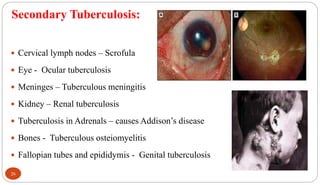 Secondary Tuberculosis:
26
 Cervical lymph nodes – Scrofula
 Eye - Ocular tuberculosis
 Meninges – Tuberculous meningitis
 Kidney – Renal tuberculosis
 Tuberculosis in Adrenals – causes Addison’s disease
 Bones - Tuberculous osteiomyelitis
 Fallopian tubes and epididymis - Genital tuberculosis
 