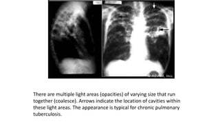 There are multiple light areas (opacities) of varying size that run
together (coalesce). Arrows indicate the location of cavities within
these light areas. The appearance is typical for chronic pulmonary
tuberculosis.
 