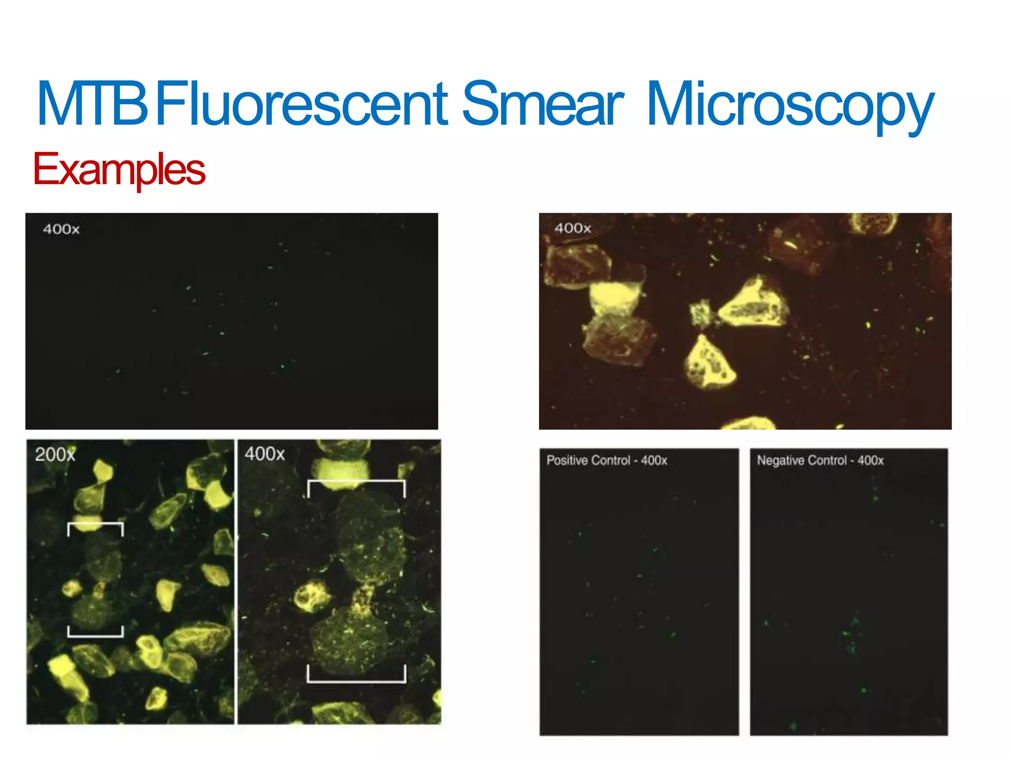 MTBFluorescent Smear Microscopy
Examples
 