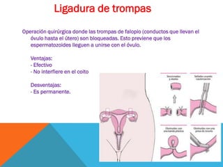 Operación quirúrgica donde las trompas de falopio (conductos que llevan el
óvulo hasta el útero) son bloqueadas. Esto previene que los
espermatozoides lleguen a unirse con el óvulo.
Ventajas:
- Efectivo
- No interfiere en el coito
Desventajas:
- Es permanente.
Ligadura de trompas
 