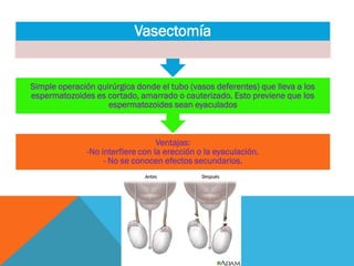 Ventajas:
-No interfiere con la erección o la eyaculación.
- No se conocen efectos secundarios.
Simple operación quirúrgica donde el tubo (vasos deferentes) que lleva a los
espermatozoides es cortado, amarrado o cauterizado. Esto previene que los
espermatozoides sean eyaculados
Vasectomía
 