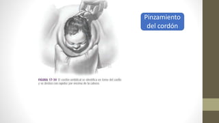 Pinzamiento
del cordón
 