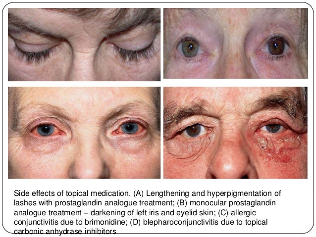 Glaucoma Latanoprost Side Effects - Astigmatism Glaucoma Swollen Eyes Disease Glaucoma Latanoprost Side Effects - Astigmatism Glaucoma Swollen Eyes Disease