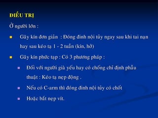 ÑIEÀU TRÒ
ÔÛ ngöôøi lôùn :
 Gaõy kín ñôn giaûn : Ñoùng ñinh noäi tuûy ngay sau khi tai naïn
hay sau keùo taï 1 - 2 tuaàn (kín, hôû)
 Gaõy kín phöùc taïp : Coù 3 phöông phaùp :
 Ñoái vôùi ngöôøi giaø yeáu hay coù choáng chæ ñònh phaãu
thuaät : Keùo taï neïp ñoäng .
 Neáu coù C-arm thì ñoùng ñinh noäi tuûy coù choát
 Hoaëc baét neïp vít.
 