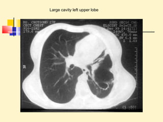 Large cavity left upper lobe 
 