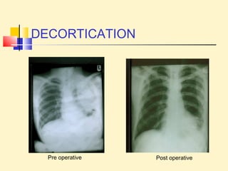 DECORTICATION 
Pre operative Post operative 
 