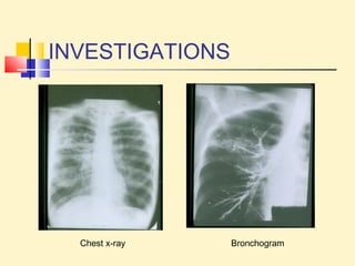 INVESTIGATIONS 
Chest x-ray Bronchogram 
 