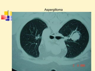 Aspergilloma 
 