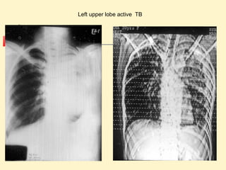 Left upper lobe active TB 
 