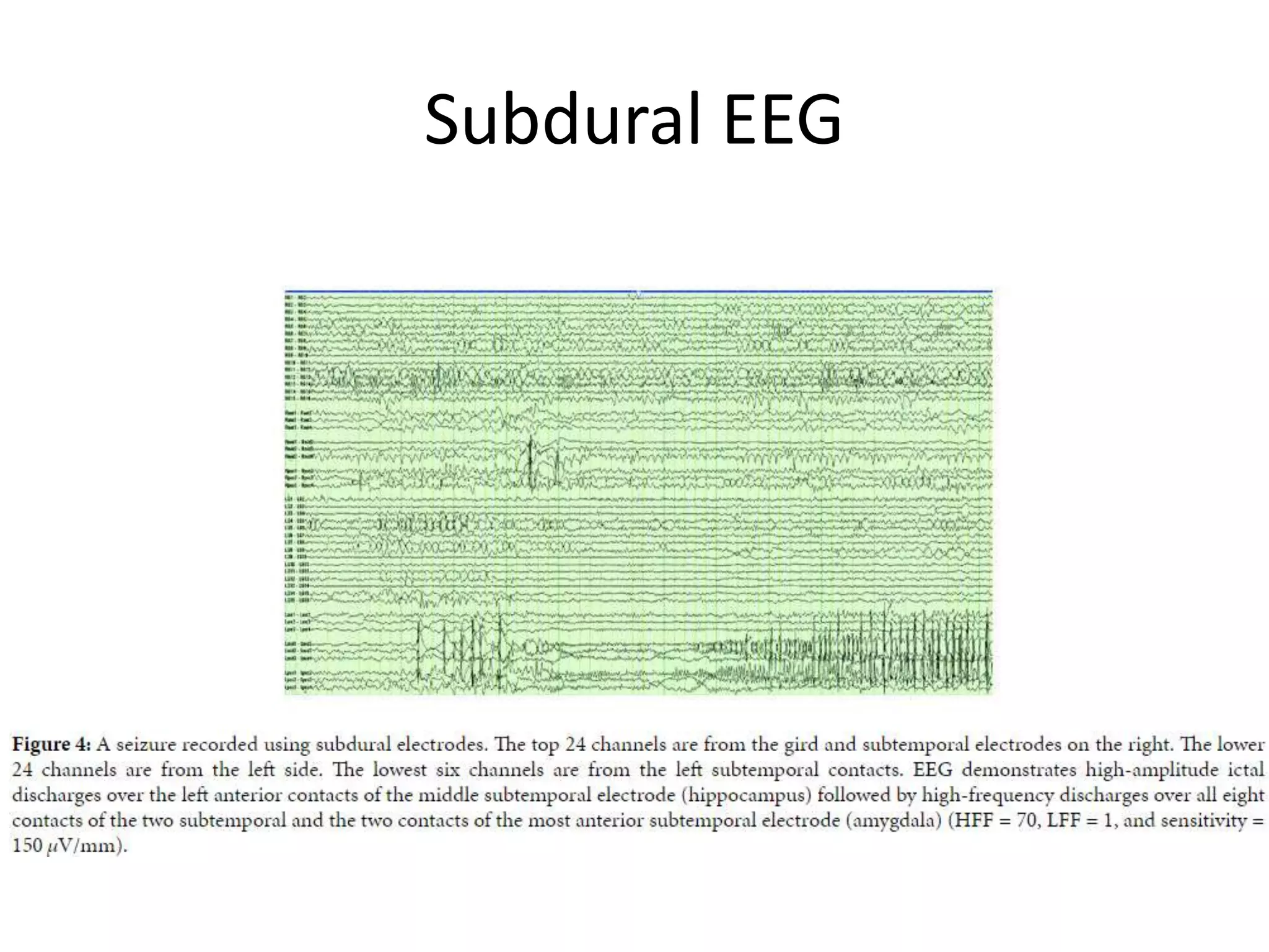 Subdural EEG
 