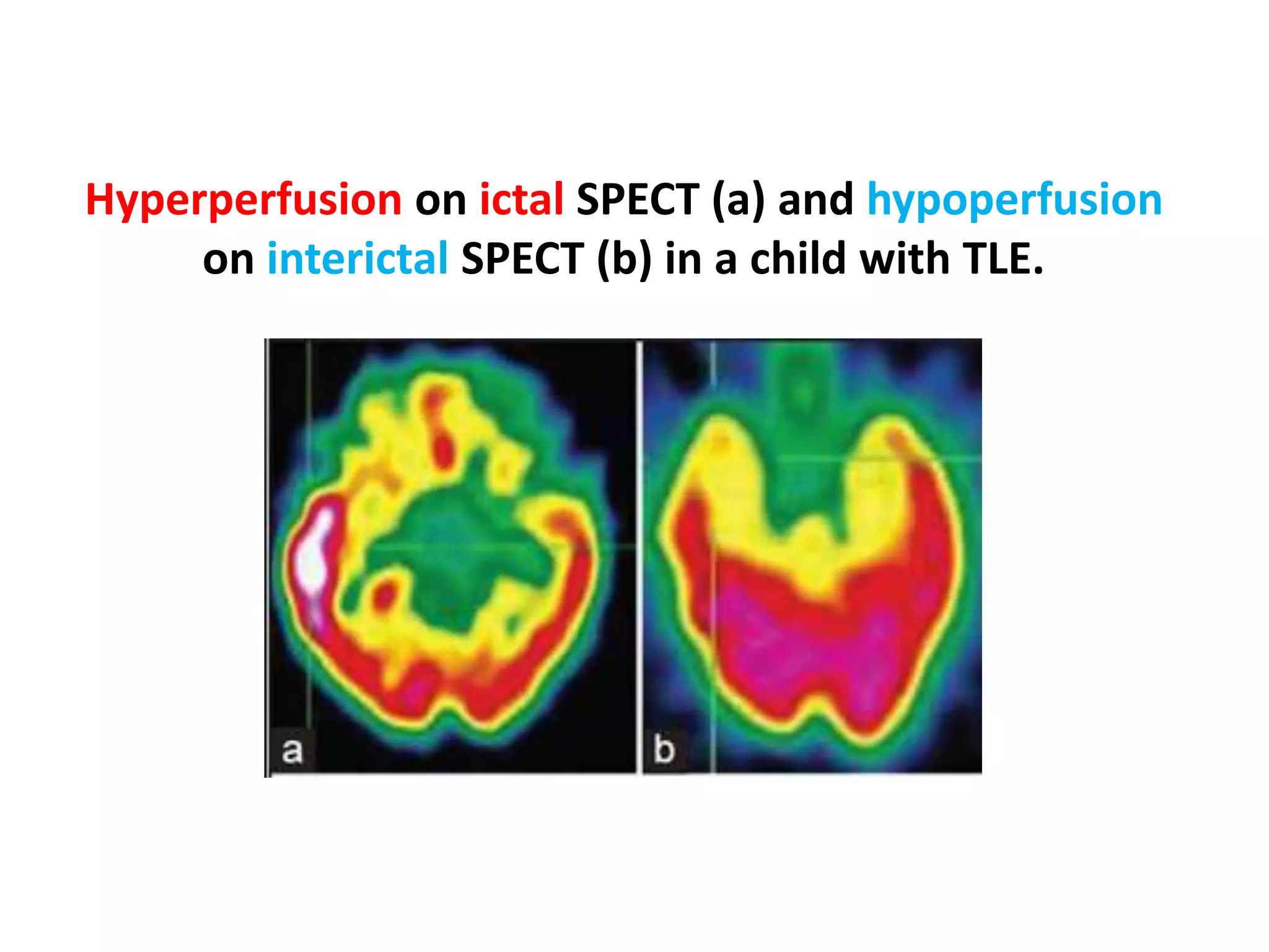Hyperperfusion on ictal SPECT (a) and hypoperfusion
on interictal SPECT (b) in a child with TLE.
 