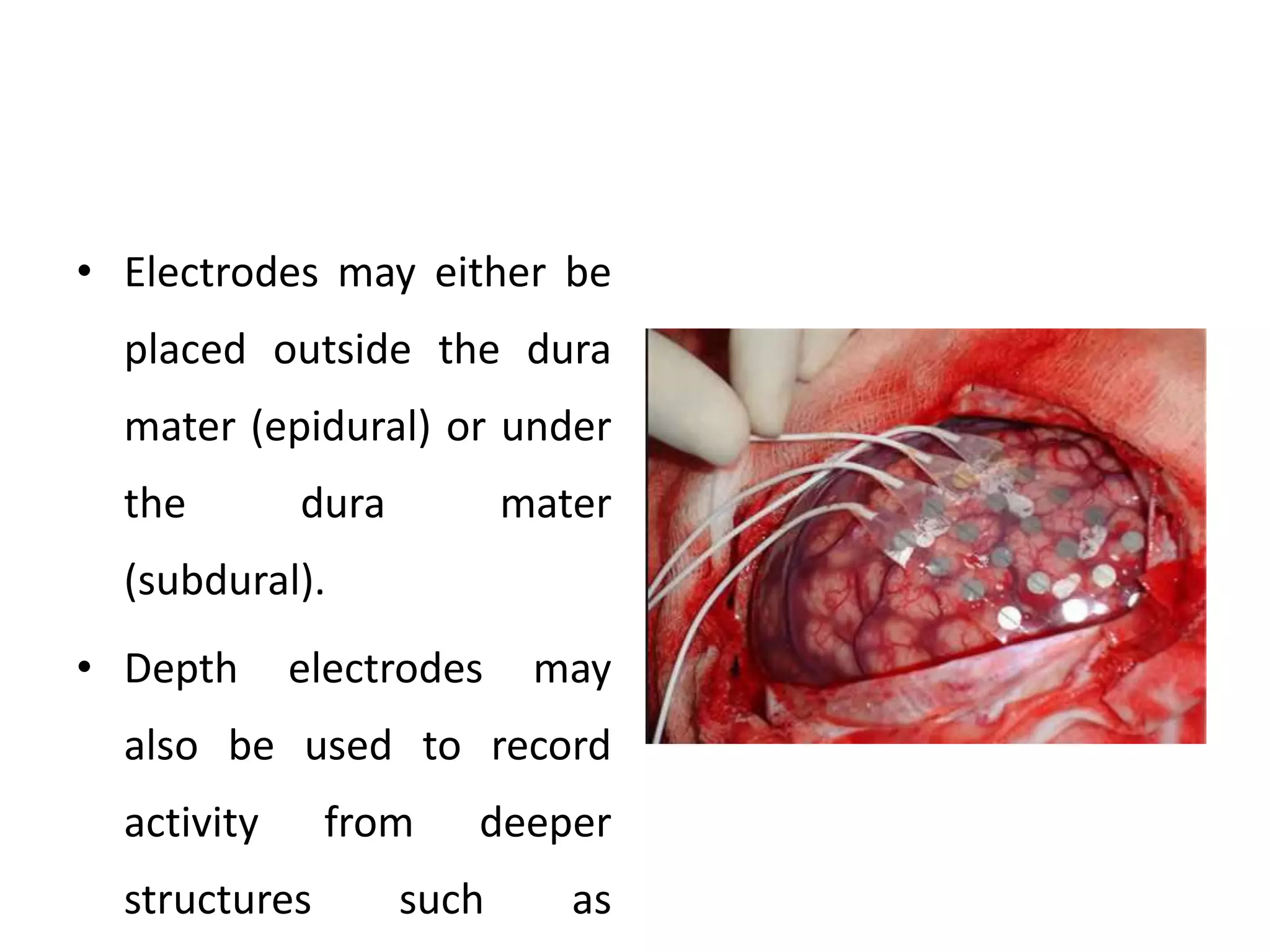 • Electrodes may either be
placed outside the dura
mater (epidural) or under
the dura mater
(subdural).
• Depth electrodes may
also be used to record
activity from deeper
structures such as
 