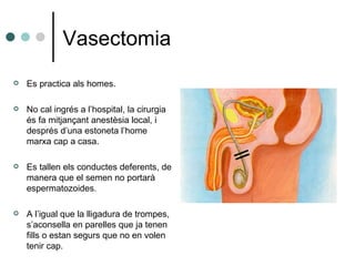 Vasectomia Es practica als homes. No cal ingrés a l’hospital, la cirurgia és fa mitjançant anestèsia local, i després d’una estoneta l’home marxa cap a casa. Es tallen els conductes deferents, de manera que el semen no portarà espermatozoides. A l’igual que la lligadura de trompes, s’aconsella en parelles que ja tenen fills o estan segurs que no en volen tenir cap. 