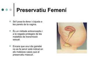 Preservatiu Femení Se’l posa la dona i s’ajusta a les parets de la vagina. És un mètode anticonceptiu i a la vegada protegeix de les malalties de transmissió sexual. Encara que avui dia gairebé no es fa servir  està indicat en els mateixos casos que el preservatiu masculí. 