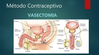 Método Contraceptivo
VASECTOMIA
 