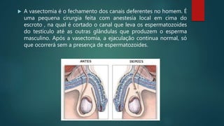  A vasectomia é o fechamento dos canais deferentes no homem. É
uma pequena cirurgia feita com anestesia local em cima do
escroto , na qual é cortado o canal que leva os espermatozoides
do testículo até as outras glândulas que produzem o esperma
masculino. Após a vasectomia, a ejaculação continua normal, só
que ocorrerá sem a presença de espermatozoides.
 