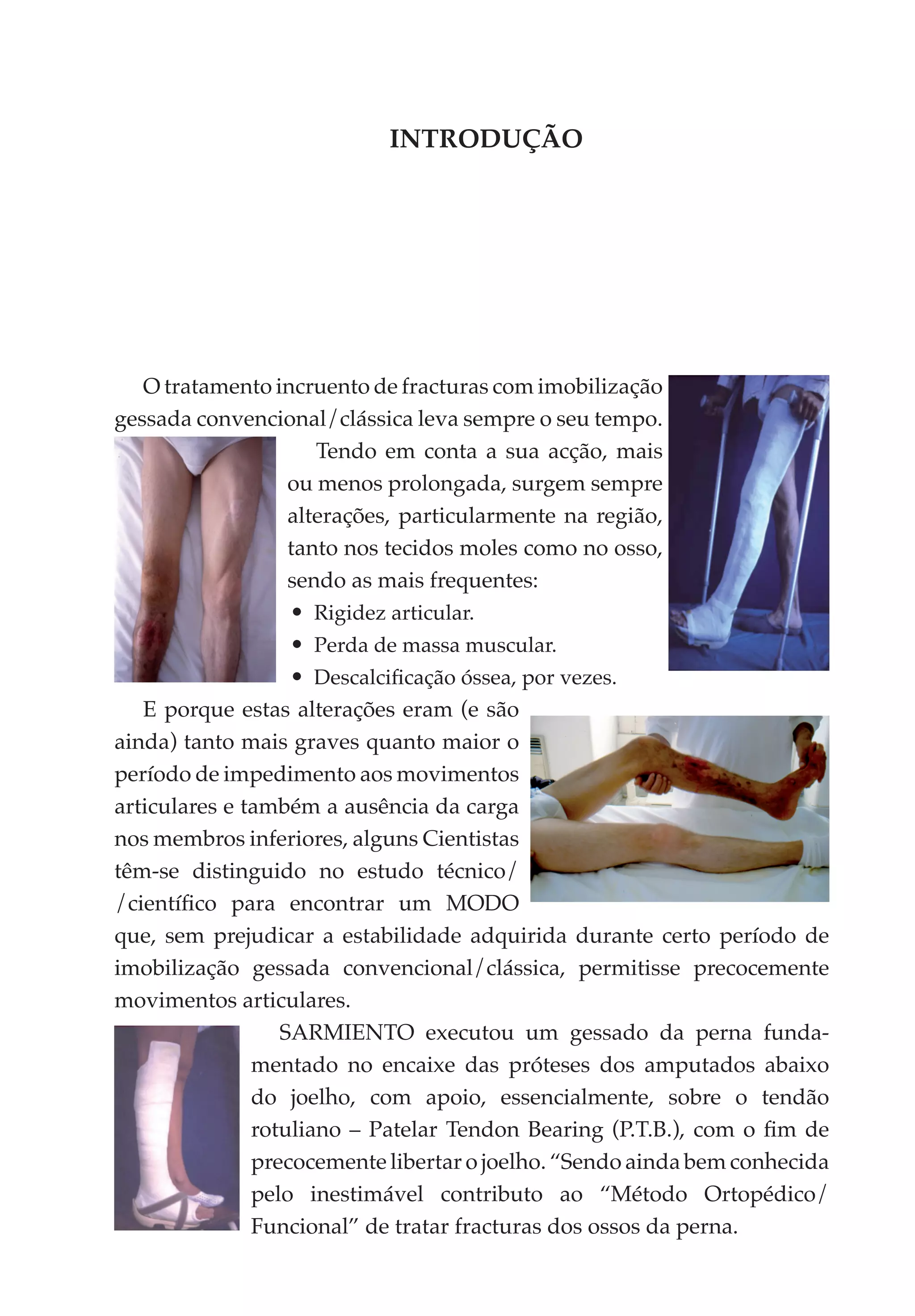 INTRODUÇÃO




   O tratamento incruento de fracturas com imobilização
gessada convencional/clássica leva sempre o seu tempo.
                      Tendo em conta a sua acção, mais
                   ou menos prolongada, surgem sempre
                   alterações, particular­ ente na região,
                                         m
                   tanto nos tecidos moles como no osso,
                   sendo as mais frequentes:
                   •	 Rigidez articular.
                   •	 Perda de massa muscular.
                   •	 Descalcificação óssea, por vezes.
   E porque estas alterações eram (e são
ainda) tanto mais graves quanto maior o
período de impedimento aos movimentos
articulares e também a ausência da carga
nos membros inferiores, alguns Cientistas
têm-se distinguido no estudo técnico/
/cien­­ fico para encontrar um MODO
      tí­
que, sem prejudicar a estabilidade adquirida durante certo período de
imobilização gessada conven­ ional/clássica, permitisse precocemente
                                 c
movimentos articulares.
                  SARMIENTO executou um gessado da perna funda­
               mentado no encaixe das próteses dos amputados abaixo
               do joelho, com apoio, essencialmente, sobre o tendão
               rotuliano – Patelar Tendon Bearing (P.T.B.), com o fim de
               precocemente libertar o joelho. “Sendo ainda bem conhecida
               pelo inestimável contributo ao “Método Ortopédico/
               Funcional” de tratar fracturas dos ossos da perna.
 