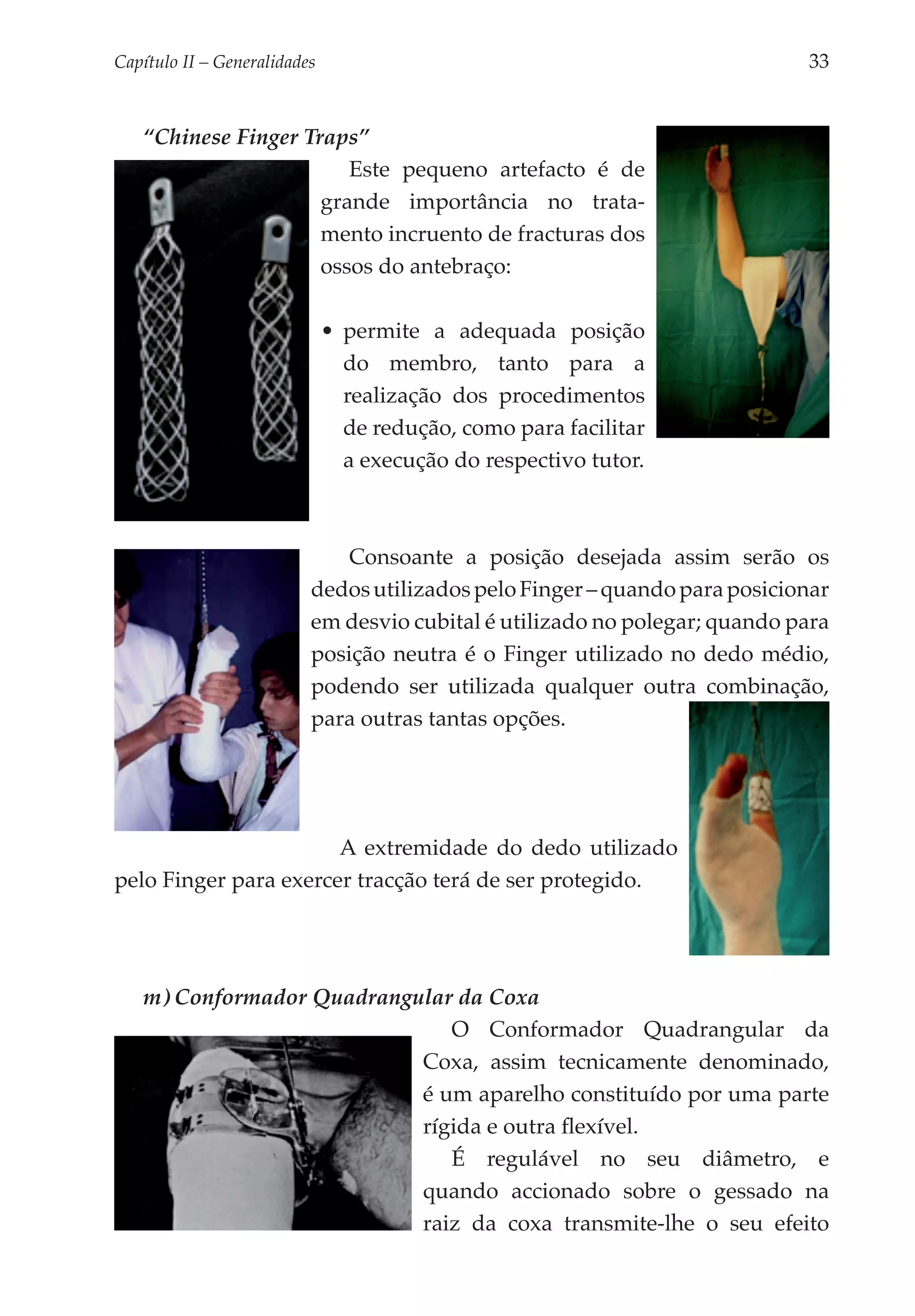 Capítulo II – Generalidades 	                                                33


   “Chinese Finger Traps”
                        Este pequeno artefacto é de
                     grande impor­ ância no trata­
                                    t
                     mento incruento de fracturas dos
                     ossos do antebraço:

                            •	 permite a adequada posição
                               do membro, tanto para a
                               realização dos procedimentos
                               de redução, como para facilitar
                               a execução do respectivo tutor.



                               Consoante a posição desejada assim serão os
                           dedos utilizados pelo Finger – quando para posicionar
                           em desvio cubital é utilizado no polegar; quando para
                           posição neutra é o Finger utilizado no dedo médio,
                           podendo ser utilizada qualquer outra combinação,
                           para outras tantas opções.




                       A extremidade do dedo utilizado
pelo Finger para exercer tracção terá de ser protegido.




   m) Conformador Quadrangular da Coxa
                              O Conformador Quadrangular da
                           Coxa, assim tecnicamente denominado,
                           é um aparelho constituído por uma parte
                           rígida e outra flexível.
                              É regulável no seu diâmetro, e
                           quando accionado sobre o gessado na
                           raiz da coxa transmite-lhe o seu efeito
 