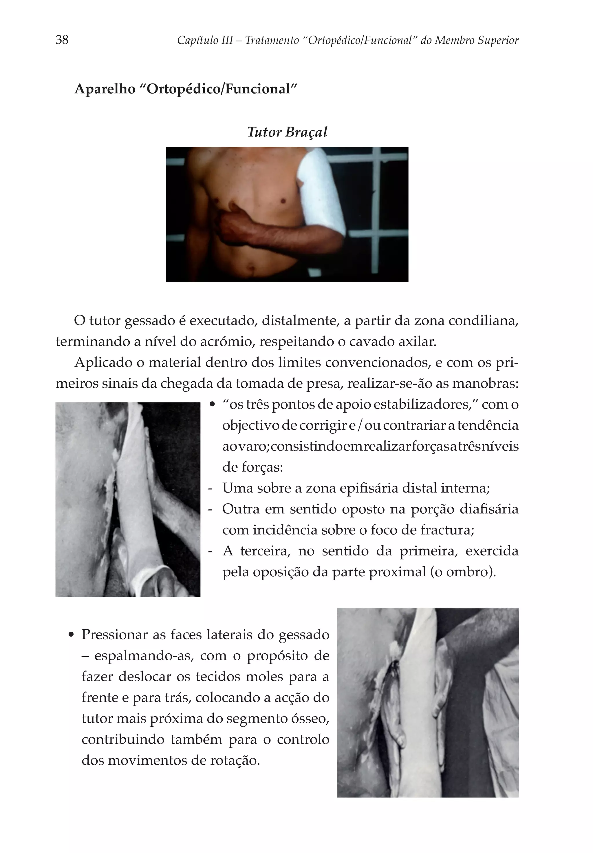 38	                  Capítulo III – Tratamento “Ortopédico/Funcional” do Membro Superior



      Aparelho “Ortopédico/Funcional”


                                  Tutor Braçal




   O tutor gessado é executado, distal­ ente, a partir da zona condiliana,
                                        m
termi­ ando a nível do acrómio, respeitando o cavado axilar.
     n
   Aplicado o material dentro dos limites convencio­ ados, e com os pri­
                                                        n
meiros sinais da chegada da tomada de presa, realizar-se-ão as manobras:
                        •	 “os três pontos de apoio estabilizadores,” com o
                           objectivo de corrigir e/ou contrariar a tendência
                           ao varo; consistindo em realizar forças a três níveis
                           de forças:
                        -- Uma sobre a zona epifisária distal interna;
                        -- Outra em sentido oposto na porção diafisária
                           com incidência sobre o foco de fractura;
                        -- A terceira, no sentido da primeira, exercida
                           pela oposição da parte proximal (o ombro).



  •	 Pressionar as faces laterais do gessado
     – espalmando-as, com o propósito de
     fazer deslocar os tecidos moles para a
     frente e para trás, colocando a acção do
     tutor mais próxima do segmento ósseo,
     contribuindo também para o controlo
     dos movimentos de rotação.
 