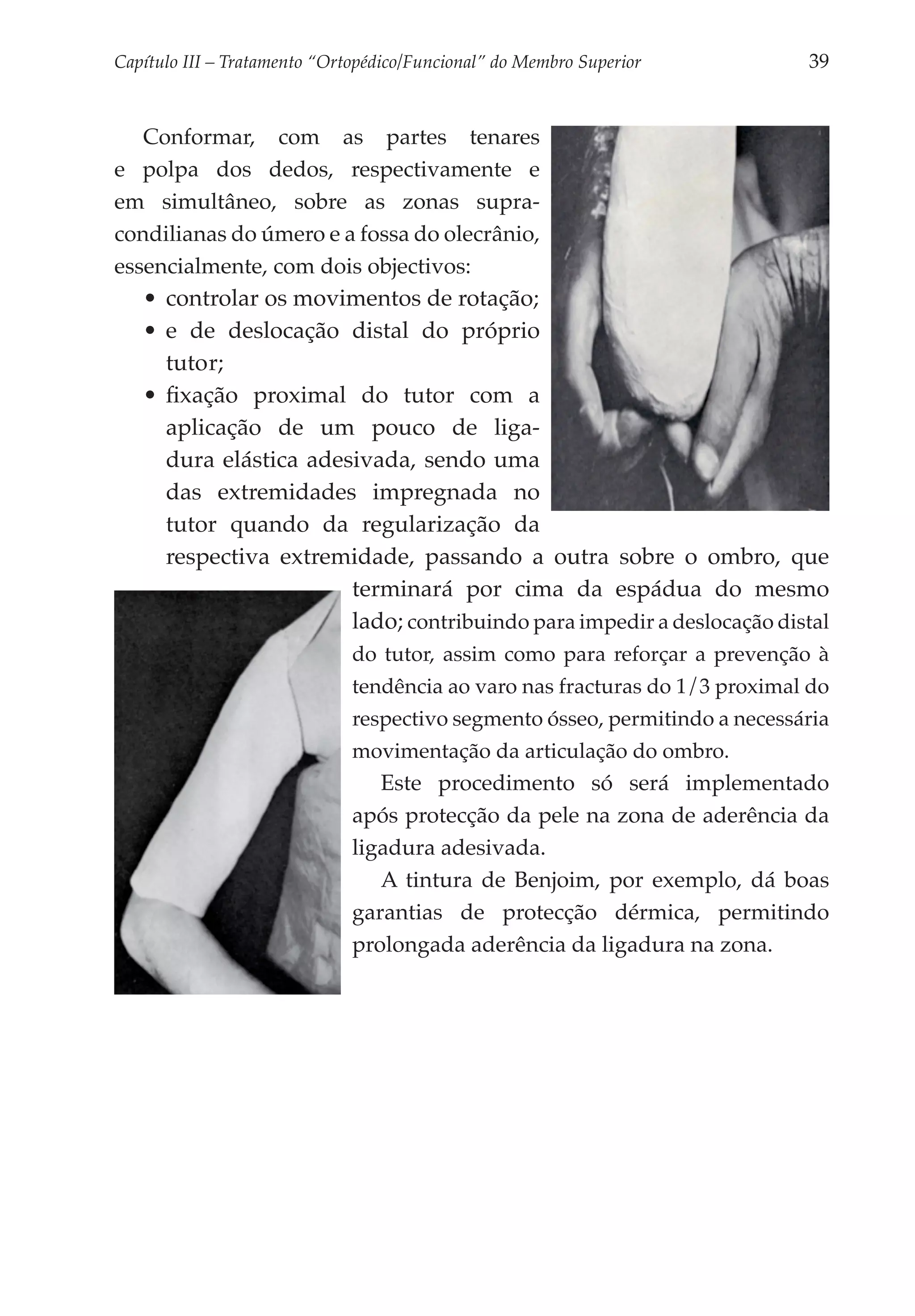 Capítulo III – Tratamento “Ortopédico/Funcional” do Membro Superior 	   39


   Conformar, com as partes tenares
e polpa dos dedos, respectivamente e
em simultâneo, sobre as zonas supra-
condilianas do úmero e a fossa do olecrânio,
essencialmente, com dois objectivos:
   •	 controlar os movimentos de rotação;
   •	 e de deslocação distal do próprio
      tutor;
   •	 fixação proximal do tutor com a
      aplicação de um pouco de liga­
      dura elástica adesivada, sendo uma
      das extremidades impregnada no
      tutor quando da regularização da
      respectiva extremidade, passando a outra sobre o ombro, que
                        terminará por cima da espádua do mesmo
                        lado; contribuindo para impedir a deslocação distal
                        do tutor, assim como para reforçar a prevenção à
                        tendência ao varo nas fracturas do 1/3 proximal do
                        respectivo segmento ósseo, permitindo a necessária
                        movimentação da articulação do ombro.
                           Este procedimento só será implementado
                        após protecção da pele na zona de aderência da
                        ligadura adesivada.
                           A tintura de Benjoim, por exemplo, dá boas
                        garantias de protecção dérmica, permitindo
                        prolongada aderência da ligadura na zona.
 