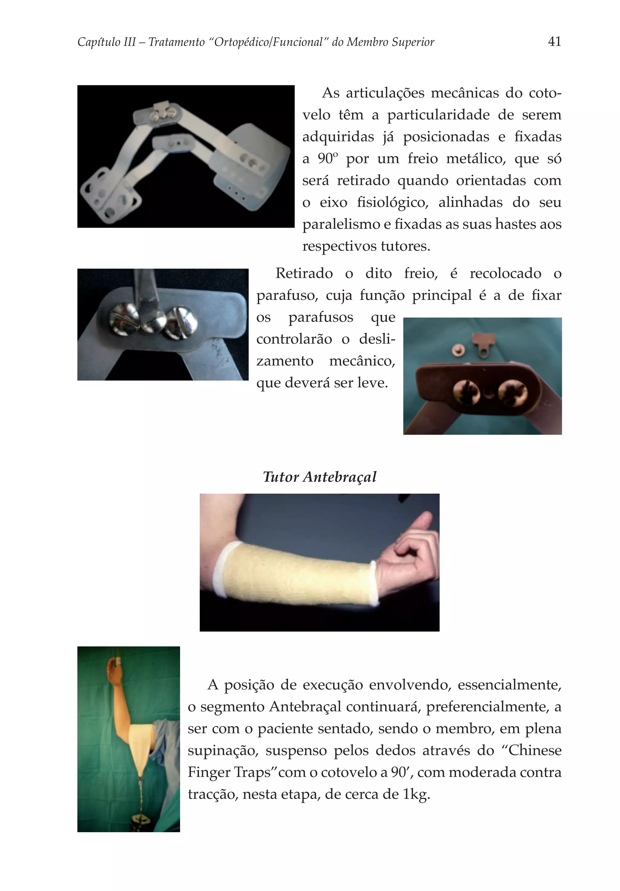 Capítulo III – Tratamento “Ortopédico/Funcional” do Membro Superior 	          41


                                             As articulações mecânicas do coto­
                                          velo têm a particularidade de serem
                                          adquiridas já posicionadas e fixadas
                                          a 90º por um freio metálico, que só
                                          será retirado quando orientadas com
                                          o eixo fisiológico, alinha­­
                                                                     das do seu
                                          paralelismo e fixadas as suas hastes aos
                                          respectivos tutores.
                                    Retirado o dito freio, é reco­ ocado o
                                                                     l
                                 parafuso, cuja fun­ ão principal é a de fixar
                                                    ç
                                 os parafusos que
                                 controlarão o desli­
                                 zamento mecânico,
                                 que deverá ser leve.




                                   Tutor Antebraçal




                       A posição de execução envolvendo, essencialmente,
                    o segmento Antebraçal continuará, preferencialmente, a
                    ser com o paciente sentado, sendo o membro, em plena
                    supinação, suspenso pelos dedos através do “Chinese
                    Finger Traps”com o cotovelo a 90’, com moderada contra
                    tracção, nesta etapa, de cerca de 1kg.
 