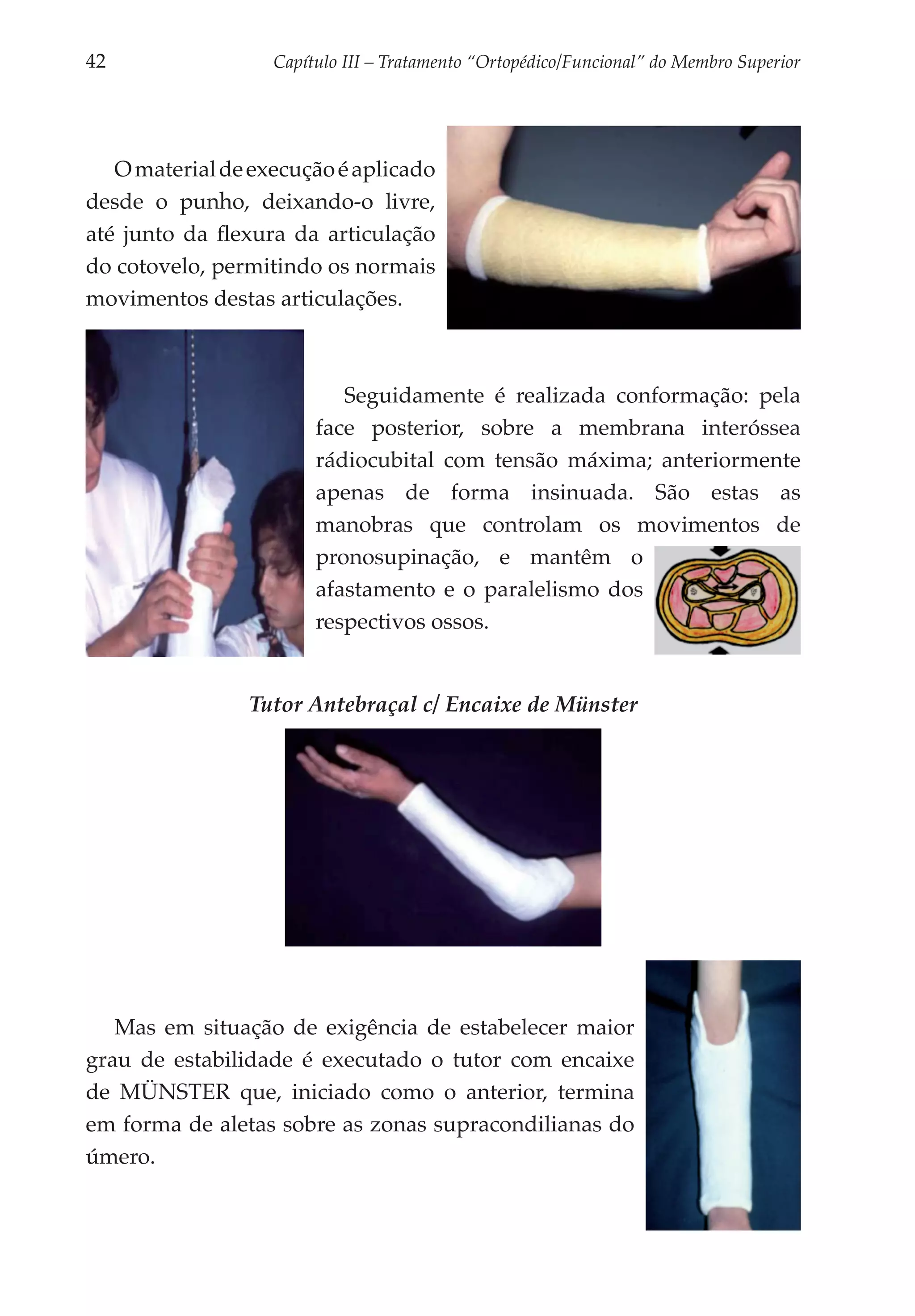 42	                Capítulo III – Tratamento “Ortopédico/Funcional” do Membro Superior




   O material de execução é aplicado
desde o punho, deixando-o livre,
até junto da flexura da articulação
do cotovelo, permitindo os normais
movimentos destas articulações.



                           Seguidamente é realizada conformação: pela
                        face posterior, sobre a membrana interóssea
                        rádiocubital com tensão máxima; anteriormente
                        apenas de forma insinuada. São estas as
                        manobras que controlam os movimentos de
                        pronosupinação, e mantêm o
                        afastamento e o paralelismo dos
                        respectivos ossos.


                Tutor Antebraçal c/ Encaixe de Münster




   Mas em situação de exigência de estabelecer maior
grau de estabilidade é executado o tutor com encaixe
de MÜNSTER que, iniciado como o anterior, termina
em forma de aletas sobre as zonas supracondilianas do
úmero.
 