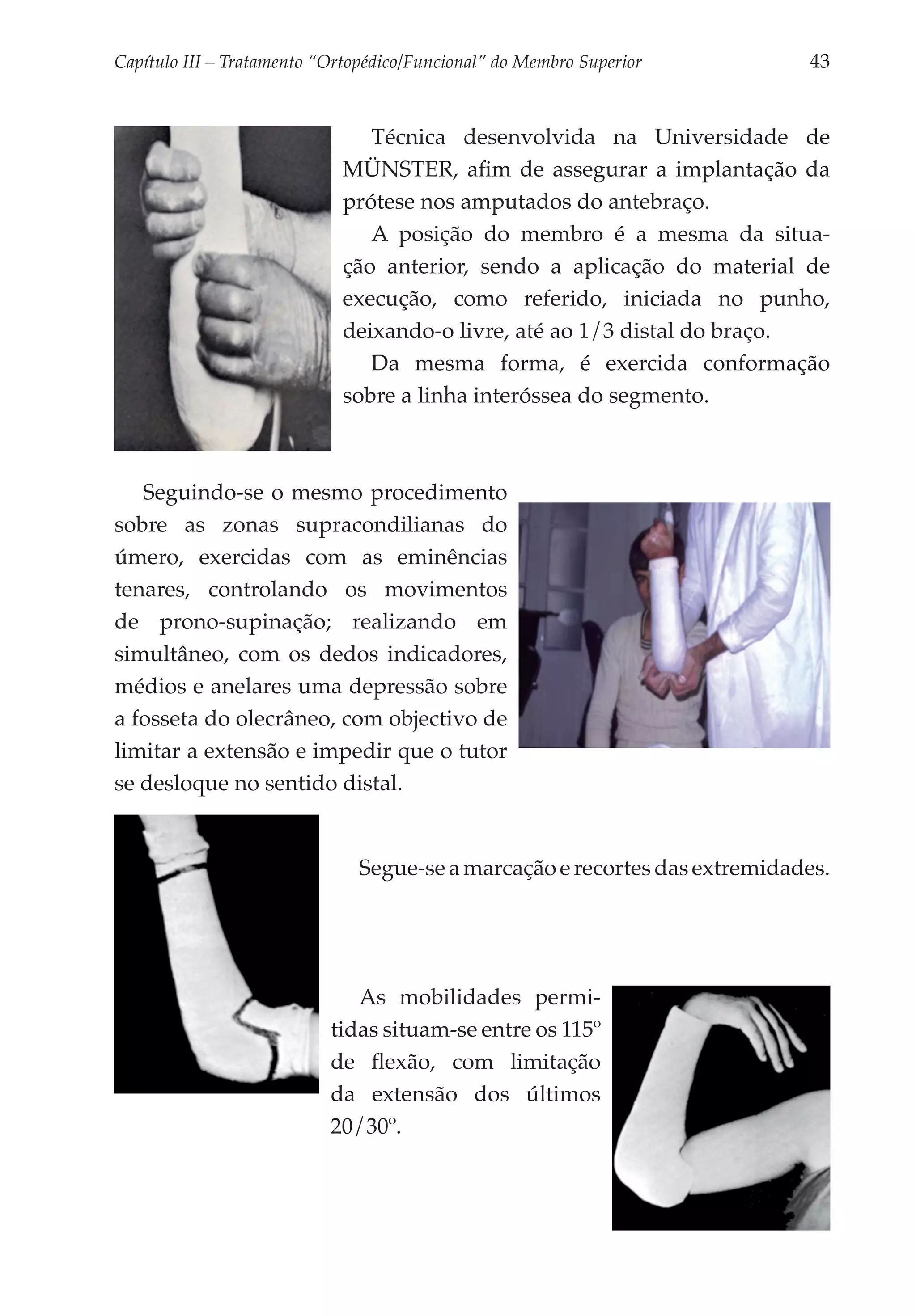 Capítulo III – Tratamento “Ortopédico/Funcional” do Membro Superior 	       43


                                Técnica desenvolvida na Universidade de
                             MÜNSTER, afim de assegurar a implantação da
                             prótese nos amputados do antebraço.
                                A posição do membro é a mesma da situa­
                             ção anterior, sendo a aplicação do material de
                             execução, como referido, iniciada no punho,
                             deixando-o livre, até ao 1/3 distal do braço.
                                Da mesma forma, é exercida conformação
                             sobre a linha interóssea do segmento.



   Seguindo-se o mesmo procedimento
sobre as zonas supracondilianas do
úmero, exercidas com as eminências
tenares, controlando os movimentos
de prono-supinação; realizando em
simultâneo, com os dedos indicadores,
médios e anelares uma depressão sobre
a fosseta do olecrâneo, com objectivo de
limitar a extensão e impedir que o tutor
se desloque no sentido distal.


                               Segue-se a marcação e recortes das extremidades.




                              As mobilidades permi­
                           tidas situam-se entre os 115º
                           de flexão, com limitação
                           da extensão dos últimos
                           20/30º.
 