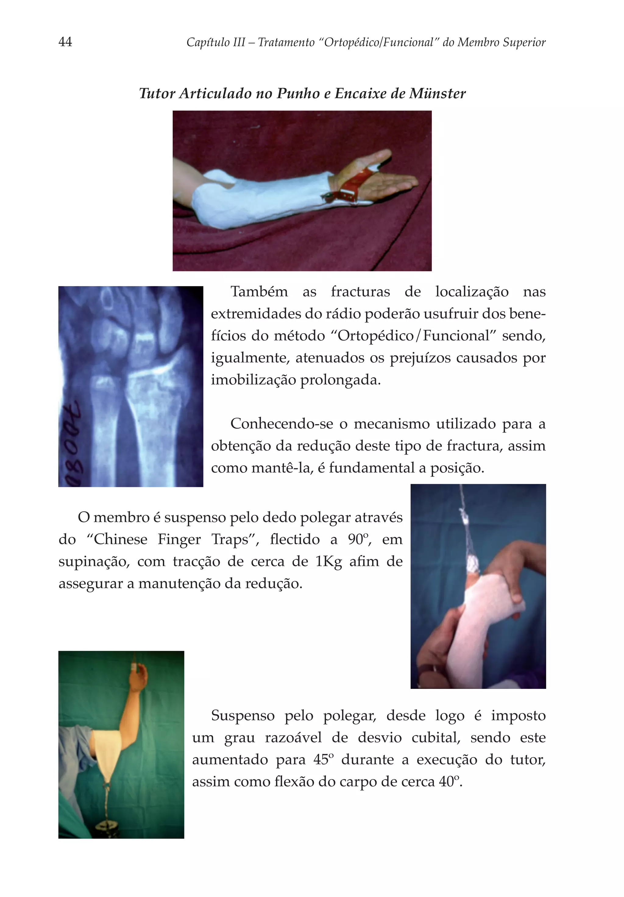 44	              Capítulo III – Tratamento “Ortopédico/Funcional” do Membro Superior



           Tutor Articulado no Punho e Encaixe de Münster




                         Também as fracturas de loca­ ização nas
                                                          l
                     extremidades do rádio poderão usufruir dos bene­
                     fícios do método “Ortopé­ ico/Funcional” sendo,
                                               d
                     igual­ ente, atenuados os prejuízos causados por
                           m
                     imobi­ ização prolongada.
                            l

                        Conhecendo-se o mecanismo utilizado para a
                     obtenção da redução deste tipo de fractura, assim
                     como mantê-la, é fundamental a posição.


   O membro é suspenso pelo dedo polegar através
do “Chinese Finger Traps”, flectido a 90º, em
supinação, com tracção de cerca de 1Kg afim de
assegurar a manutenção da redução.




                     Suspenso pelo polegar, desde logo é imposto
                  um grau razoável de desvio cubital, sendo este
                  aumentado para 45º durante a execução do tutor,
                  assim como flexão do carpo de cerca 40º.
 