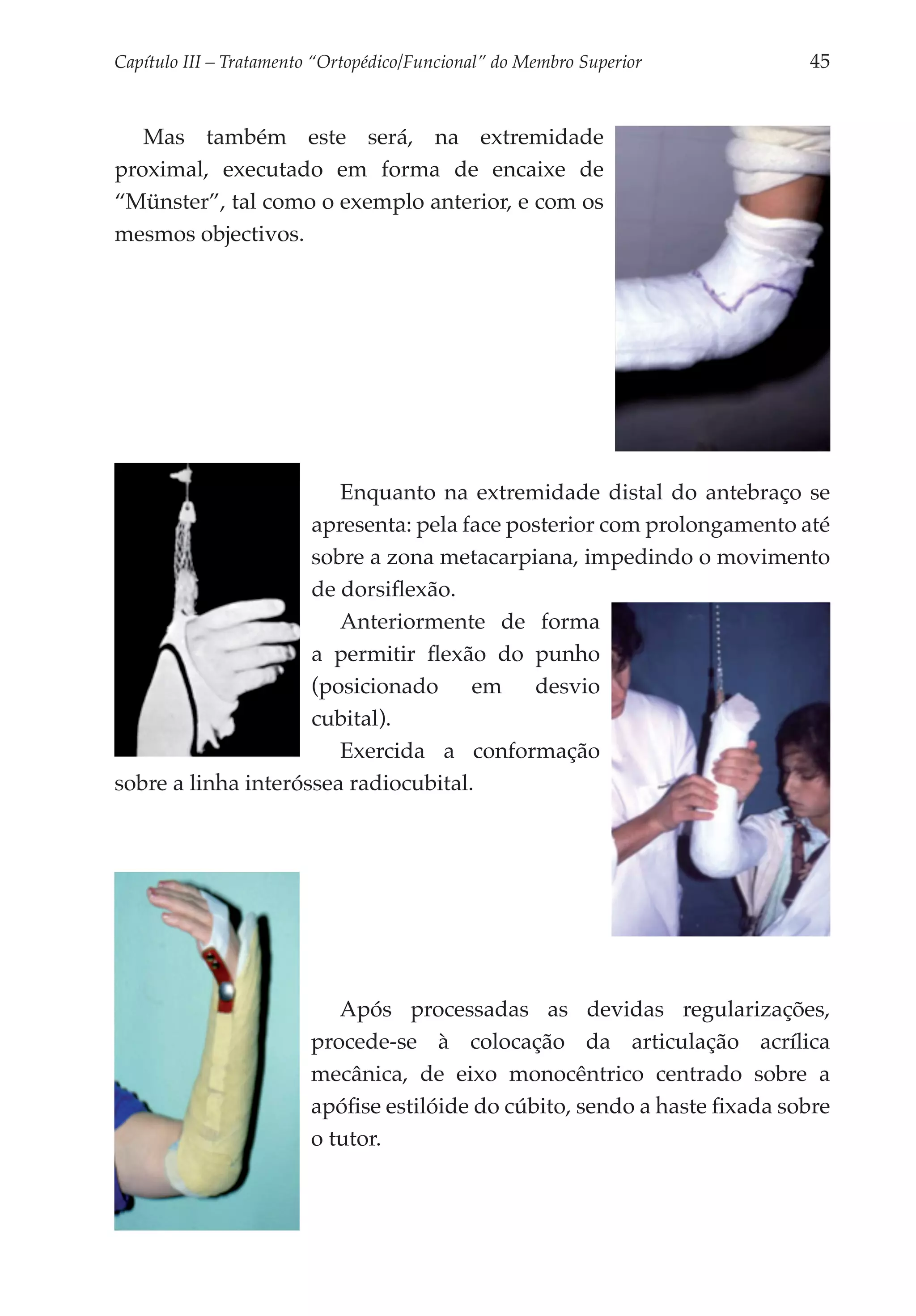 Capítulo III – Tratamento “Ortopédico/Funcional” do Membro Superior 	        45


   Mas também este será, na extremidade
proximal, executado em forma de encaixe de
“Münster”, tal como o exemplo anterior, e com os
mesmos objectivos.




                        Enquanto na extremidade distal do antebraço se
                     apresenta: pela face posterior com prolongamento até
                     sobre a zona metacarpiana, impedindo o movimento
                     de dorsiflexão.
                        Anteriormente de forma
                     a permitir flexão do punho
                     (posicionado     em    desvio
                     cubital).
                        Exercida a conformação
sobre a linha interóssea radiocubital.




                            Após processadas as devidas regularizações,
                         procede-se à colocação da articulação acrílica
                         mecânica, de eixo monocêntrico centrado sobre a
                         apófise estilóide do cúbito, sendo a haste fixada sobre
                         o tutor.
 