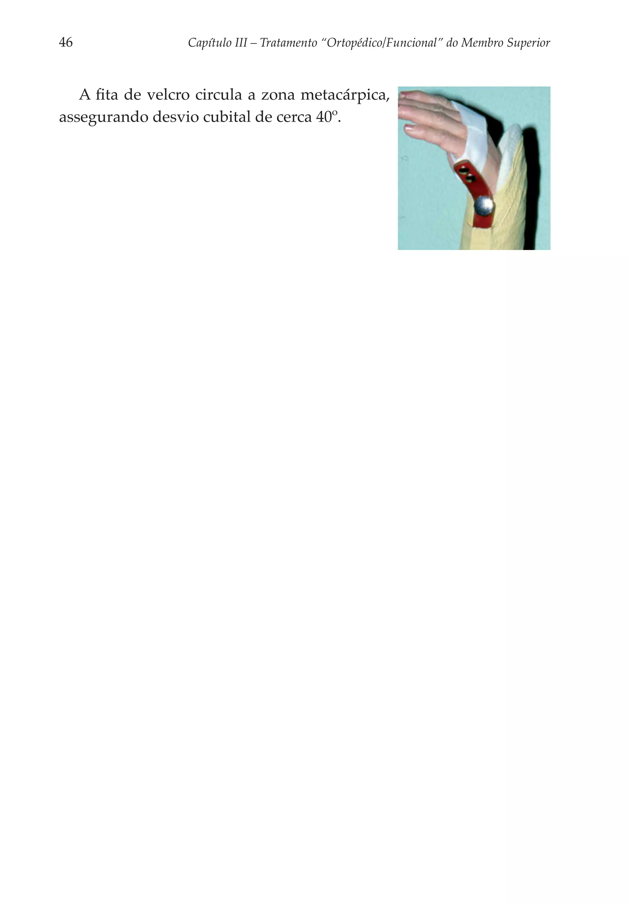 46	               Capítulo III – Tratamento “Ortopédico/Funcional” do Membro Superior



   A fita de velcro circula a zona meta­ árpica,
                                       c
assegurando desvio cubital de cerca 40º.
 