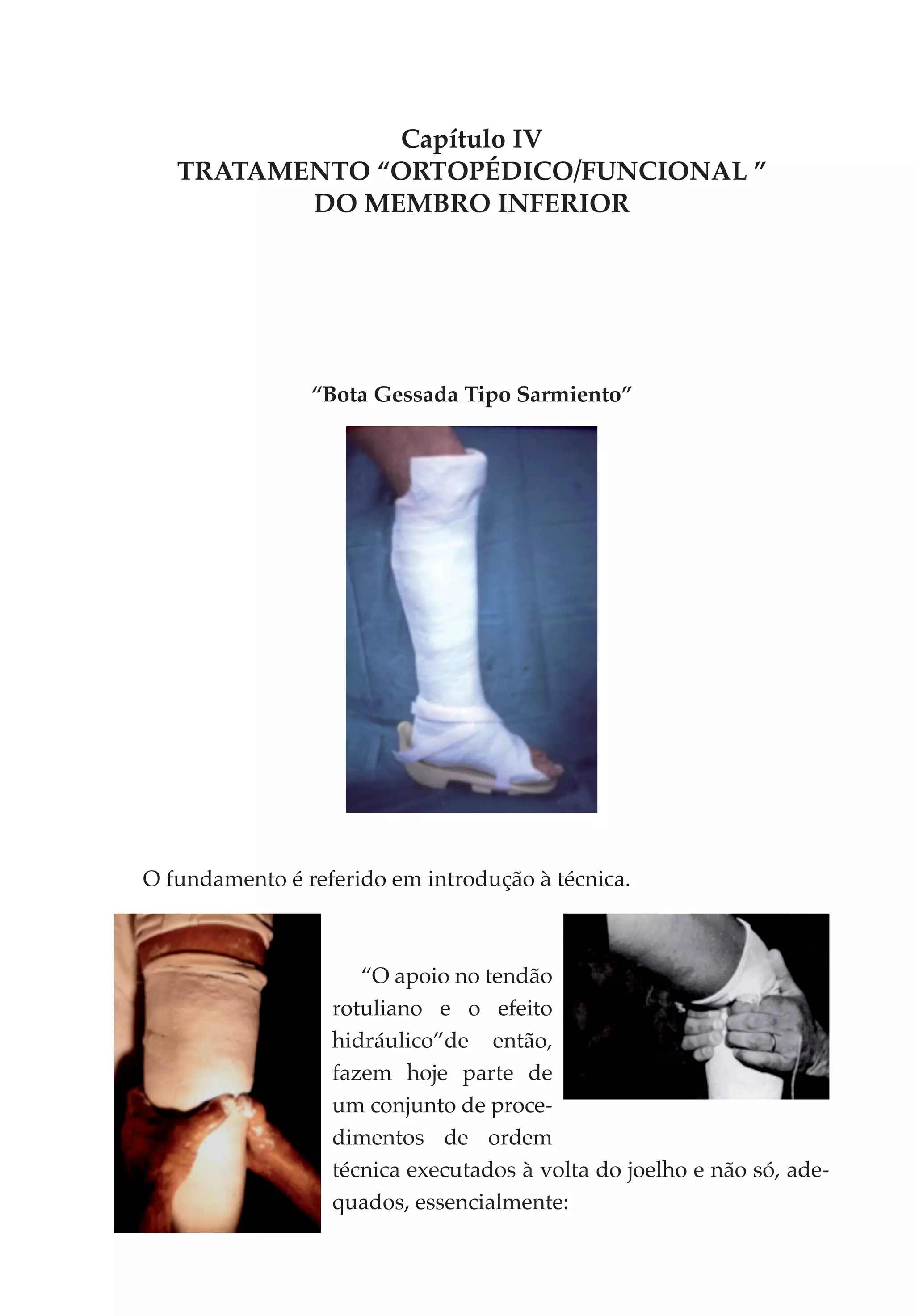 Capítulo IV
   TRATAMENTO “ORTOPÉDICO/FUNCIONAL ”
          DO MEMBRO INFERIOR




                “Bota Gessada Tipo Sarmiento”




O fundamento é referido em introdução à técnica.



                     “O apoio no tendão
                  rotuliano e o efeito
                  hidráulico”de então,
                  fazem hoje parte de
                  um con­unto de proce­
                          j
                  dimentos de ordem
                  técnica executados à volta do joelho e não só, ade­
                  qua­ os, essencialmente:
                      d
 