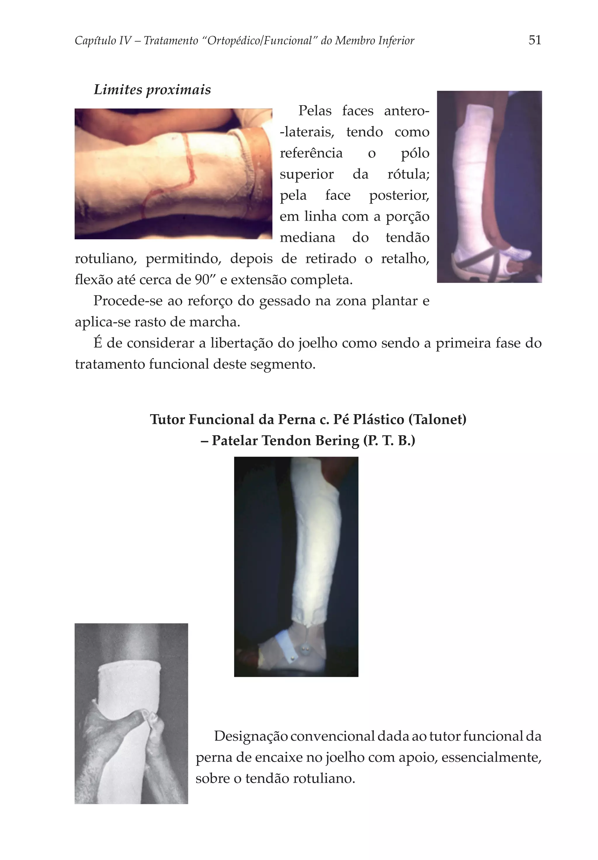 Capítulo IV – Tratamento “Ortopédico/Funcional” do Membro Inferior 	     51


   Limites proximais
                                     Pelas faces antero-
                                 -laterais, tendo como
                                 refe­ ência
                                      r        o   pólo
                                 superior da rótula;
                                 pela face posterior,
                                 em linha com a porção
                                 mediana do tendão
rotuliano, permitindo, depois de retirado o retalho,
flexão até cerca de 90” e extensão completa.
   Procede-se ao reforço do gessado na zona plantar e
aplica-se rasto de marcha.
   É de considerar a libertação do joelho como sendo a primeira fase do
tratamento funcional deste segmento.


              Tutor Funcional da Perna c. Pé Plástico (Talonet)
                     – Patelar Tendon Bering (P. T. B.)




                          Designação convencional dada ao tutor funcional da
                       perna de encaixe no joelho com apoio, essencialmente,
                       sobre o tendão rotuliano.
 