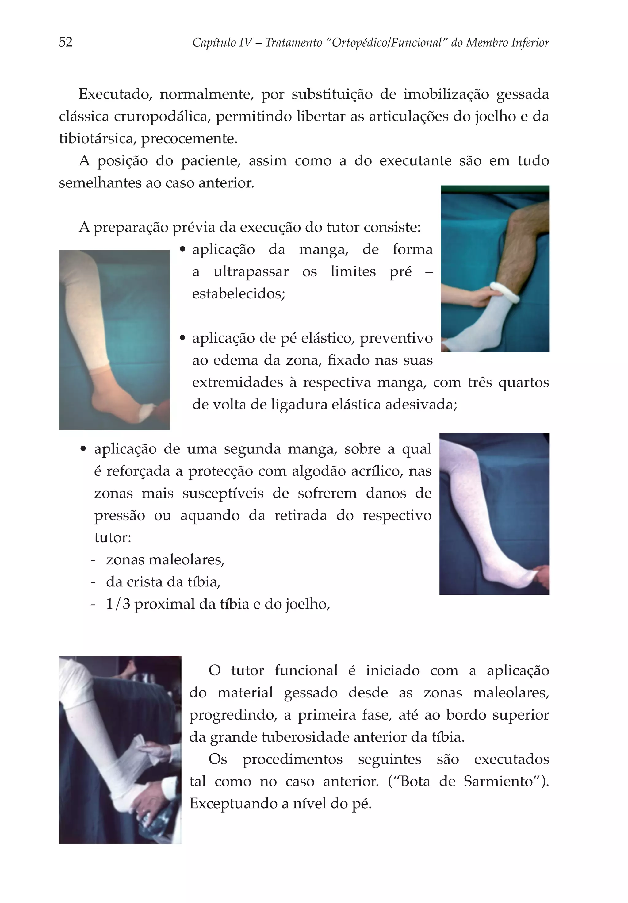 52	                   Capítulo IV – Tratamento “Ortopédico/Funcional” do Membro Inferior



   Executado, normalmente, por substituição de imobilização gessada
clássica cruropodálica, permitindo libertar as articulações do joelho e da
tibiotársica, precocemente.
   A posição do paciente, assim como a do executante são em tudo
semelhantes ao caso anterior.

      A preparação prévia da execução do tutor consiste:
                    •	aplicação da manga, de forma
                      a ultrapassar os limites pré –
                      estabelecidos;

                    •	aplicação de pé elástico, preventivo
                      ao edema da zona, fixado nas suas
                      extremidades à respectiva manga, com três quartos
                      de volta de ligadura elástica adesivada;

      •	 aplicação de uma segunda manga, sobre a qual
         é reforçada a protecção com algodão acrílico, nas
         zonas mais susceptíveis de sofrerem danos de
         pressão ou aquando da retirada do respectivo
         tutor:
        -- zonas maleolares,
        -- da crista da tíbia,
        -- 1/3 proximal da tíbia e do joelho,



                         O tutor funcional é iniciado com a aplicação
                      do material gessado desde as zonas maleolares,
                      progredindo, a primeira fase, até ao bordo superior
                      da grande tuberosidade anterior da tíbia.
                         Os procedimentos seguintes são executados
                      tal como no caso anterior. (“Bota de Sarmiento”).
                      Exceptuando a nível do pé.
 