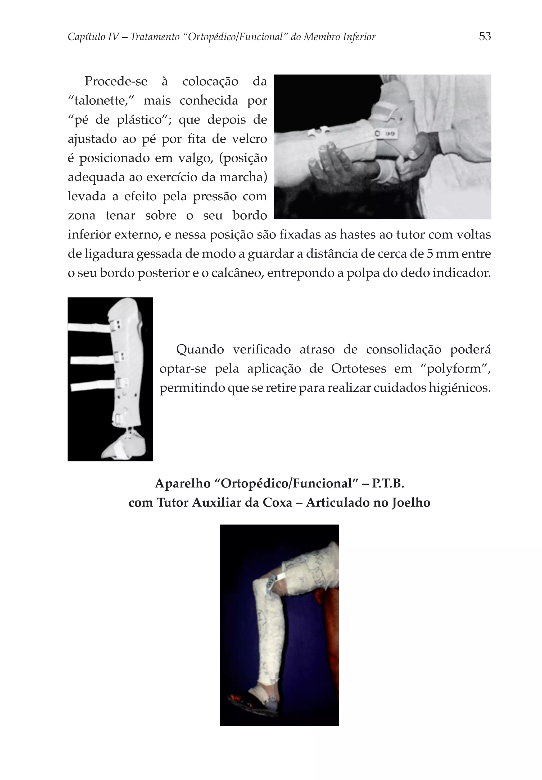 Capítulo IV – Tratamento “Ortopédico/Funcional” do Membro Inferior 	       53


   Procede-se à colocação da
“talonette,” mais conhecida por
“pé de plástico”; que depois de
ajustado ao pé por fita de velcro
é posicionado em valgo, (posição
adequada ao exercício da marcha)
levada a efeito pela pressão com
zona tenar sobre o seu bordo
inferior externo, e nessa posição são fixadas as hastes ao tutor com voltas
de ligadura gessada de modo a guardar a distância de cerca de 5 mm entre
o seu bordo posterior e o calcâneo, entrepondo a polpa do dedo indicador.




                      Quando verificado atraso de consolidação poderá
                   optar-se pela aplicação de Ortoteses em “polyform”,
                   permitindo que se retire para realizar cuidados higiénicos.




                Aparelho “Ortopédico/Funcional” – P.T.B.
             com Tutor Auxiliar da Coxa – Articulado no Joelho
 