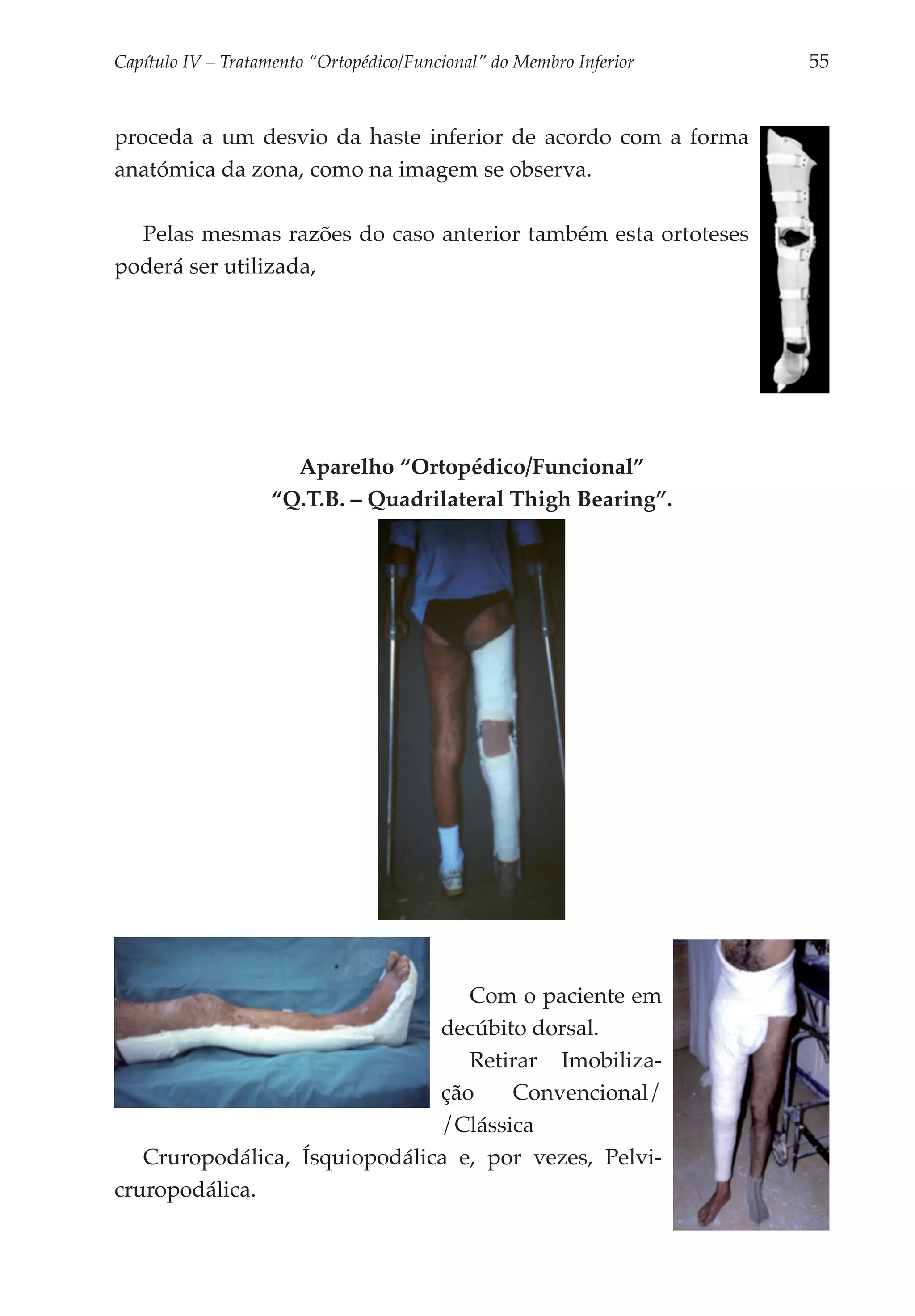 Capítulo IV – Tratamento “Ortopédico/Funcional” do Membro Inferior 	   55


proceda a um desvio da haste inferior de acordo com a forma
anatómica da zona, como na imagem se observa.

  Pelas mesmas razões do caso anterior também esta ortoteses
poderá ser utilizada,




                      Aparelho “Ortopédico/Funcional”
                    “Q.T.B. – Quadrilateral Thigh Bearing”.




                                  Com o paciente em
                               decúbito dorsal.
                                  Retirar Imo­ i­ i­ a­
                                                blz
                               ção    Conven­ ional/
                                             c
                               /Clássica
   Cruropodálica, Ísquiopodálica e, por vezes, Pelvi­
cruropodálica.
 