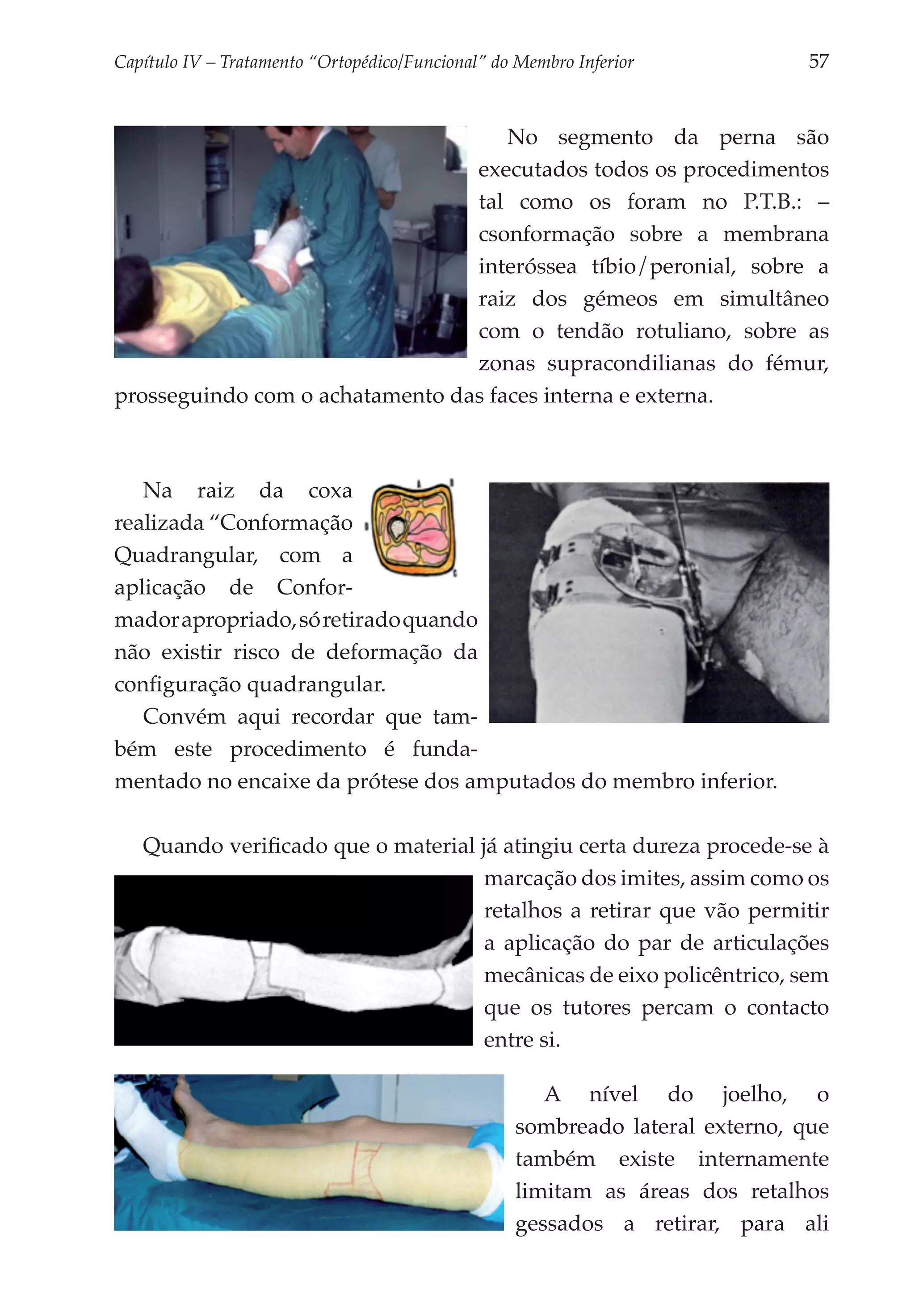 Capítulo IV – Tratamento “Ortopédico/Funcional” do Membro Inferior 	           57


                                     No segmento da perna são
                                 executados todos os procedimentos
                                 tal como os foram no P.T.B.: –
                                 csonformação sobre a membrana
                                 interóssea tíbio/peronial, sobre a
                                 raiz dos gémeos em simultâneo
                                 com o tendão rotuliano, sobre as
                                 zonas supracondilianas do fémur,
prosseguindo com o achatamento das faces interna e externa.



   Na raiz da coxa
realizada “Conformação
Quadrangular, com a
aplicação de Confor­
mador apropriado, só retirado quando
não existir risco de deformação da
configuração quadrangular.
   Convém aqui recordar que tam­
bém este procedimento é funda­
mentado no encaixe da prótese dos amputados do membro inferior.

   Quando verificado que o material já atingiu certa dureza procede-se à
                                     marcação dos imites, assim como os
                                     retalhos a retirar que vão permitir
                                     a aplicação do par de articulações
                                     mecânicas de eixo policêntrico, sem
                                     que os tutores percam o contacto
                                     entre si.

                                                      A nível do joelho, o
                                                   sombreado lateral externo, que
                                                   também existe internamente
                                                   limitam as áreas dos retalhos
                                                   gessados a retirar, para ali
 